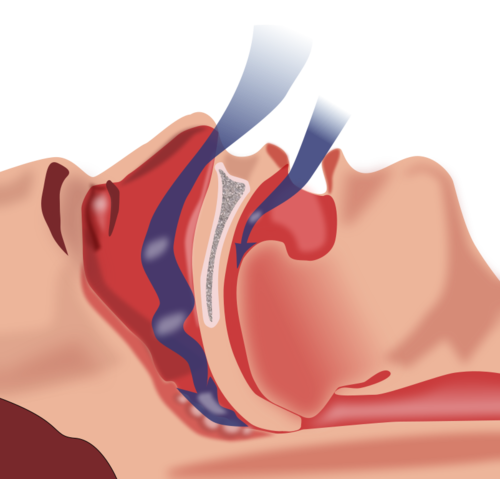 Representación explicativa de la obstrucción en la ventilación que se produce en el síndrome de apnea del sueño/Habib M’henni 