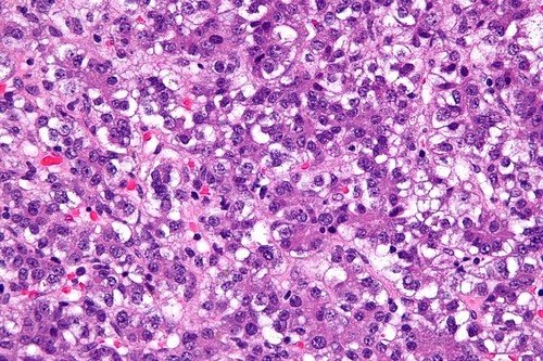 Hepatoblastoma. / Nephron.