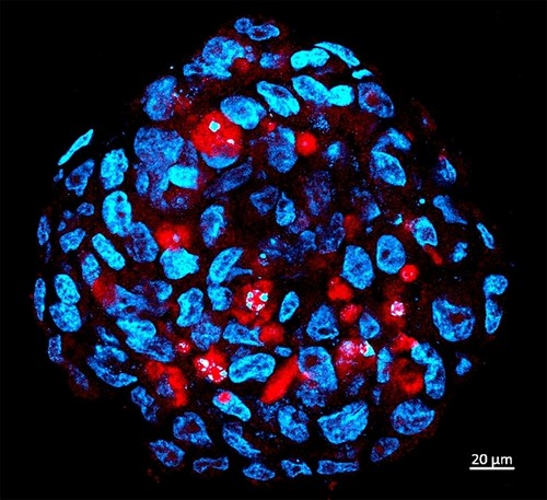 Esfera tumoral compuesta por células madre de meduloblastoma humano infectadas por el virus del Zika (en rojo)/CEGH-CEL