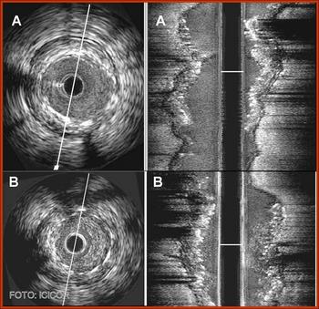 Técnica de imagen intra-arterial, estudio de ecografía intravascular.