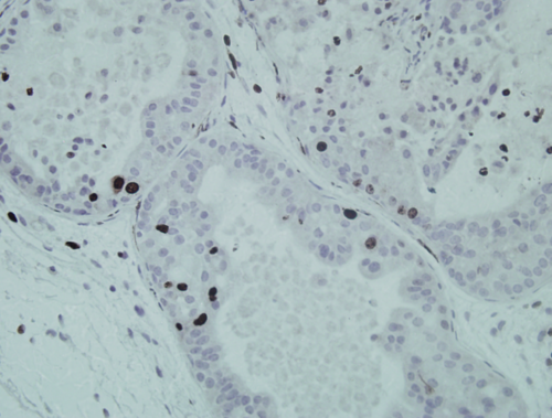 Cáncer de próstata en modelo murino. Pocas células proliferan en los tumores negativos para Mettl1. / Sandra Blanco.