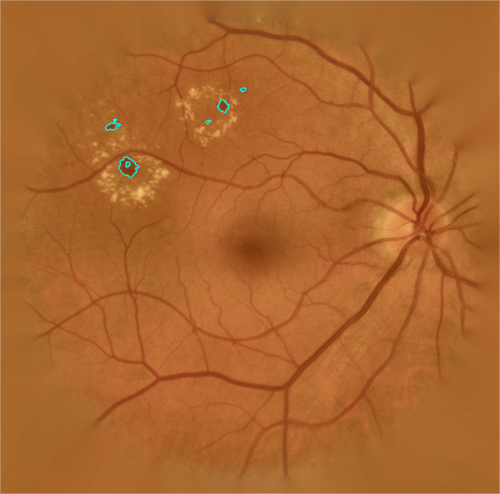 El sistema es capaz de detectar automáticamente lesiones rojas en la retina/R. Romero