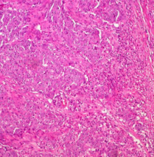 Muestra de un carcinoma medular de colon. Imagen: Ed Uthman.