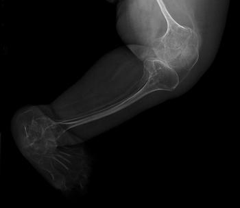 Radiografía de un paciente con osteogénesis imperfecta. Crédito: Hospital Universitario La Paz.
