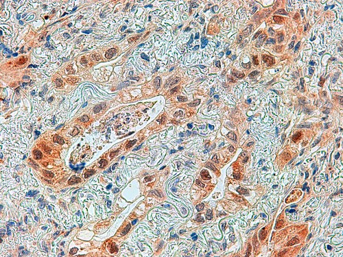 Adenocarcinoma de pulmón con la proteína ERK5 marcada en marrón en las células tumorales. / Hospital Clínico Universitario de Salamanca.