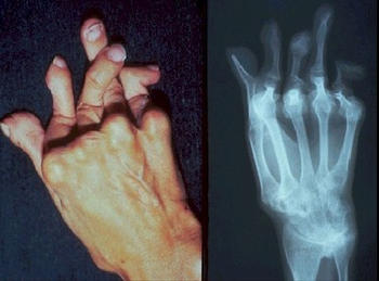 Deformaciones causadas por la artritis reumatoide.