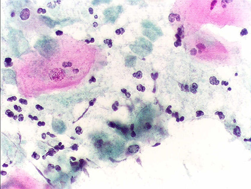 Tinción de Papanicolau de una muestra infectada por 'Trichomonas vaginalis'/Alex_brollo