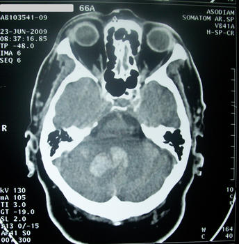 TAC que muestra un caso de accidente cerebrovascular hemorrágico.