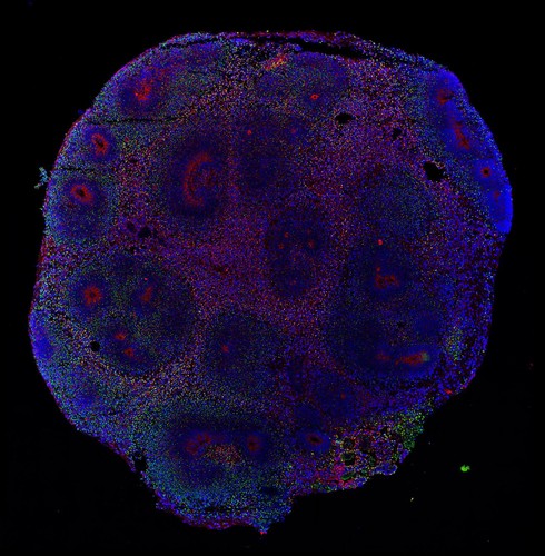 Cerebro organoide infectado por el virus zika después de 13 días. En verde, las células infectadas por el virus; en rojo, neuronas; en azul, núcleos celulares.