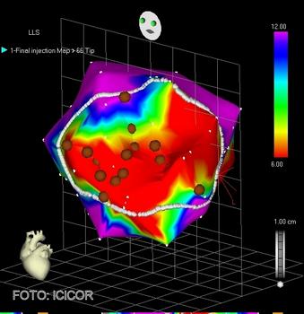 Imagen del corazón obtenida con el sistema NOGA de mapeo electromecánico. Los puntos corresponden a las zonas donde se han implantado células mesenquimales.