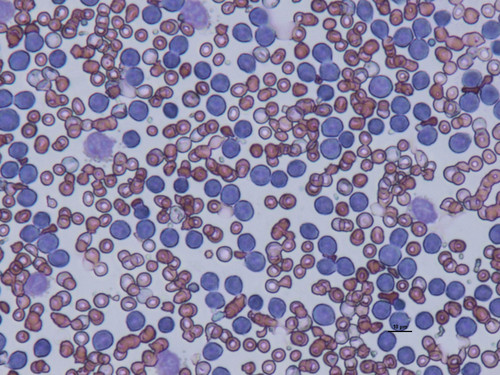 Imagen microscópica de un frotis de leucemia. Imagen: CSIC.