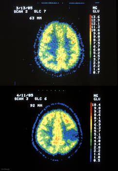 Comparación de un cerebro normal, arriba, y otro afectado por un astrocitoma, abajo, tomada de una tomografía axial computorizada (TAC).